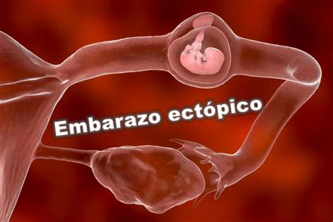 que es un embarazo ectopico - semanas en meses de embarazo